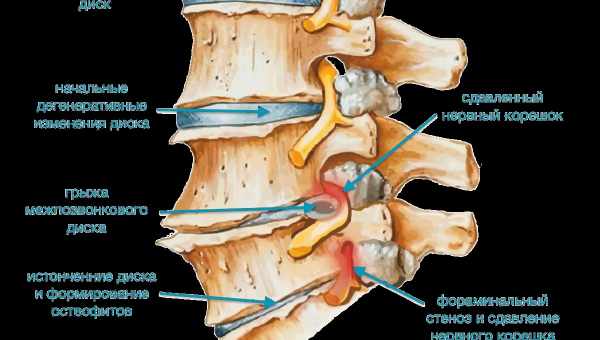 Почему возникают грыжи шейного отдела позвоночника, чем они опасны? Как лечат грыжу шейного отдела позвоночника, профилактика болей