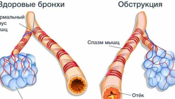 Бронхит у ребенка – причины, симптомы и лучшее лечение