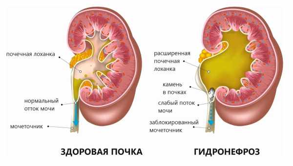 Пузырно-мочеточниковый рефлюкс – причины и лечение всех видов патологии