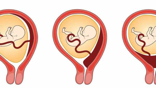 Преждевременная отслойка нормально расположенной плаценты