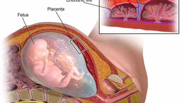 Инфаркт плаценты - что это такое?