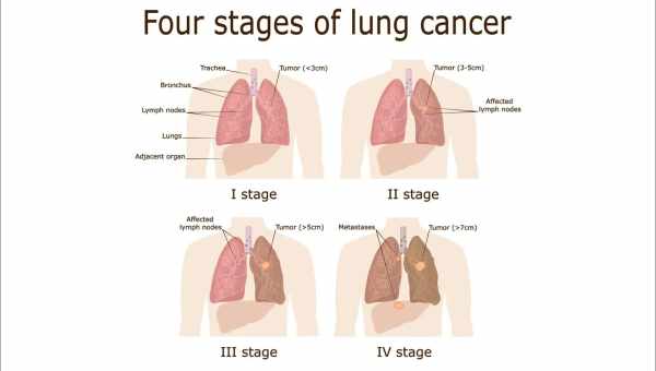 7 ранних симптомов рака легких, о которых вы могли не знать