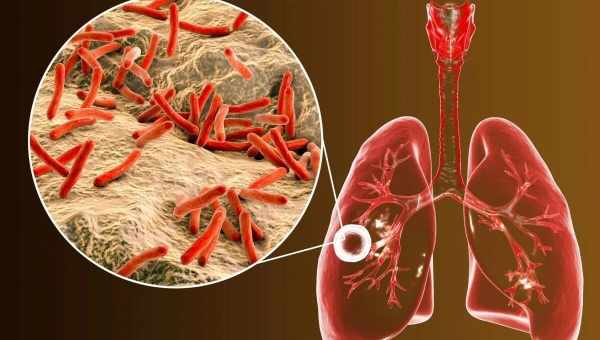 Стволовые клетки в легких приютили туберкулезные бактерии