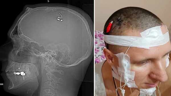 Супервезение: Парень поборол рак мозга, а через 8 лет пережил полное отделение черепа от позвоночника