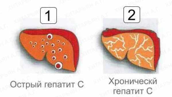 Светлый кал – типичный симптом вирусного гепатита