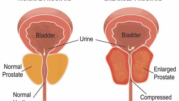 Гиперплазия предстательной железы