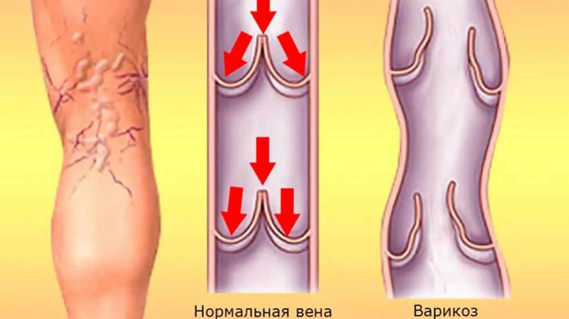 Причины развития варикоза нижних конечностей