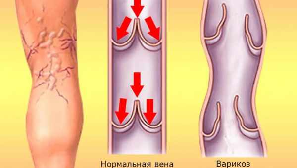 Причины развития варикоза нижних конечностей