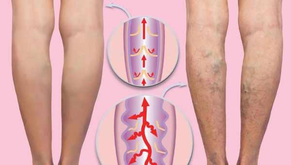 Семь упражнений для улучшения венозного кровообращения при варикозе