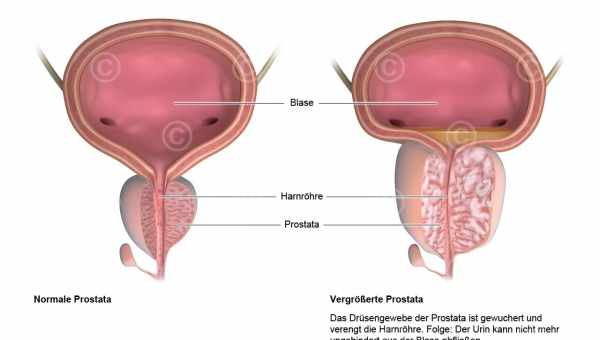 Гиперплазия предстательной железы. Лечение медопродуктами