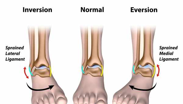 Растяжение связок голеностопа