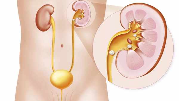 Использование бедренца в борьбе с камнями в почках