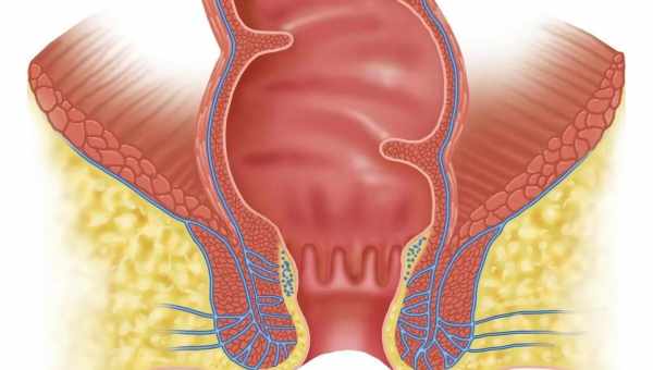 Народная медицина в борьбе с выпадением прямой кишки