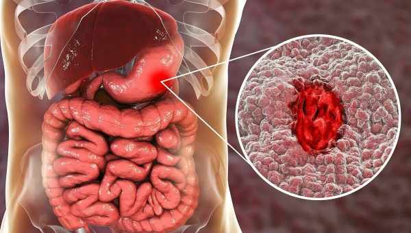 Язва желудка: 8 ранних симптомов, с которыми нужно быстрее обращаться к врачу