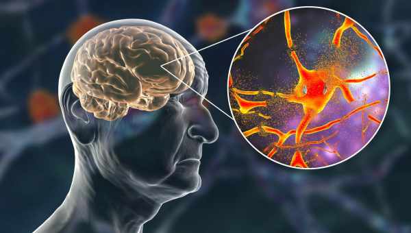 Диагностировать болезнь Альцгеймера теперь можно за четыре года до первых симптомов